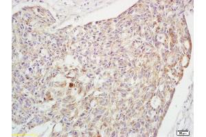 Formalin-fixed and paraffin embedded human rectal carcinoma labeled with Rabbit Anti phospho-Crkl(Tyr251) Polyclonal Antibody, Unconjugated (ABIN703420) at 1:200 followed by conjugation to the secondary antibody and DAB staining