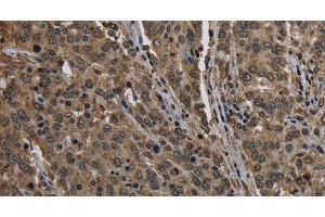 Immunohistochemistry of paraffin-embedded Human liver cancer using HIST1H2AH Polyclonal Antibody at dilution of 1:40 (HIST1H2AH antibody)