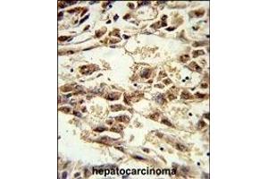 Formalin-fixed and paraffin-embedded human hepatocarcinoma reacted with AIFM2 Antibody (C-term), which was peroxidase-conjugated to the secondary antibody, followed by DAB staining. (AIFM2 antibody  (C-Term))