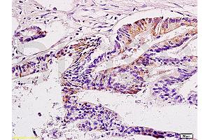 Formalin-fixed and paraffin: human gastric carcinoma labeled with Anti-CTAG2 Polyclonal Antibody, Unconjugated at 1:200 followed by conjugation to the secondary antibody and DAB staining (CTAG2 antibody  (AA 121-210))