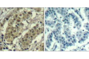 Immunohistochemical analysis of paraffin-embedded human breast carcinoma tissue using AKT1 (Ab-450) Antibody (E021502). (AKT1 antibody)