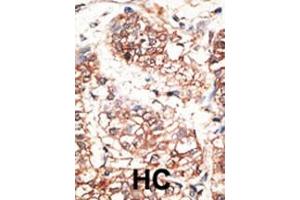 Formalin-fixed and paraffin-embedded human cancer tissue reacted with the primary antibody, which was peroxidase-conjugated to the secondary antibody, followed by AEC staining. (Neuregulin 3 antibody  (AA 305-336))
