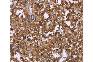 Immunohistochemistry of Human liver cancer using GPR171 Polyclonal Antibody at dilution of 1:40