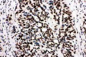 Anti-Ku80 antibody, IHC(P) IHC(P): Human Mammary Cancer Tissue (XRCC5 antibody  (C-Term))