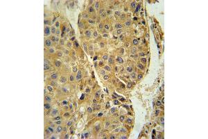TUBB3 Antibody (N-term) (ABIN651938 and ABIN2840464) immunohistochemistry analysis in formalin fixed and paraffin embedded human hepatocarcinoma followed by peroxidase conjugation of the secondary antibody and DAB staining.