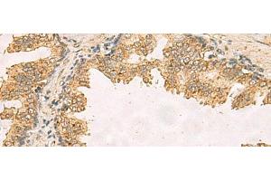 Immunohistochemistry of paraffin-embedded Human prost ate cancer tissue using RPS11 Polyclonal Antibody at dilution of 1:40(x200) (RPS11 antibody)