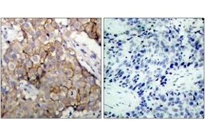 Immunohistochemistry analysis of paraffin-embedded human breast carcinoma tissue, using EGFR (Ab-1092) Antibody. (EGFR antibody  (AA 1061-1110))