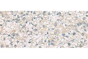 Immunohistochemistry of paraffin-embedded Human liver cancer tissue using CHMP6 Polyclonal Antibody at dilution of 1:65(x200) (CHMP6 antibody)