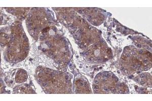 ABIN6277722 at 1/100 staining Human liver cancer tissue by IHC-P. (SPRY4 antibody  (Internal Region))
