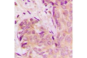Immunohistochemical analysis of TGF beta 1 staining in human breast cancer formalin fixed paraffin embedded tissue section.
