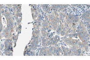 ABIN6276939 at 1/100 staining Human cervical cancer tissue by IHC-P. (EPXH2 antibody)