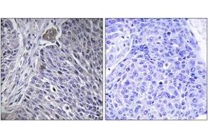 Immunohistochemistry analysis of paraffin-embedded human lung carcinoma tissue, using HNRPDL Antibody. (HNRPDL antibody  (AA 241-290))