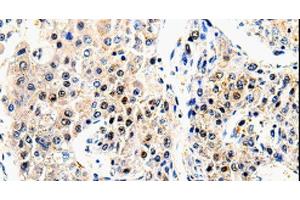 Immunohistochemistry of paraffin-embedded Human liver cancer using beta Amyloid Polyclonal Antibody at dilution of 1:100 (beta Amyloid antibody)