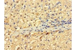 Immunohistochemistry of paraffin-embedded human liver cancer using ABIN7151164 at dilution of 1:100 (RNF182 antibody  (AA 1-160))