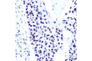 Immunohistochemistry of paraffin-embedded human esophageal cancer using Phospho-ST-S727 Rabbit mAb (ABIN7270300) at dilution of 1:100 (40x lens). (STAT1 antibody  (pSer727))