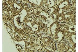 ABIN6273227 at 1/100 staining Human breast cancer tissue by IHC-P. (DIS3 antibody  (Internal Region))