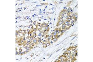 Immunohistochemistry of paraffin-embedded human colon carcinoma using PEX14 antibody.