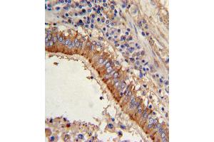 Formalin-fixed and paraffin-embedded human lung carcinoma with MVP Antibody (C-term), which was peroxidase-conjugated to the secondary antibody, followed by DAB staining. (MVP antibody  (C-Term))