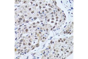 Immunohistochemistry of paraffin-embedded human lung cancer using TP53BP1 antibody (ABIN5973380) at dilution of 1/100 (40x lens).