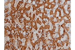 ABIN6256332 and ABIN6267233 at 1/200 staining human liver cancer tissue sections by IHC-P. (HDAC3 antibody  (pSer424))