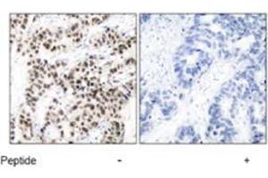 Immunohistochemical analysis of paraffin-embedded human breast carcinoma tissue using MYC polyclonal antibody  . (c-MYC antibody)