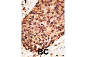 Formalin-fixed and paraffin-embedded human cancer tissue reacted with MMP16 polyclonal antibody  , which was peroxidase-conjugated to the secondary antibody, followed by AEC staining. (MMP16 antibody  (N-Term))