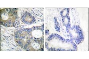 Immunohistochemistry analysis of paraffin-embedded human colon carcinoma tissue, using 4E-BP1 (Ab-64) Antibody. (eIF4EBP1 antibody  (AA 30-79))