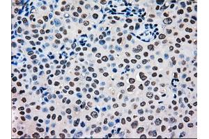 Immunohistochemical staining of paraffin-embedded Carcinoma of pancreas tissue using anti-MRI1mouse monoclonal antibody. (MRI1 antibody)