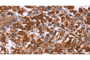 Immunohistochemistry of paraffin-embedded Human thyroid cancer using ING2 Polyclonal Antibody at dilution of 1:40 (ING2 antibody)