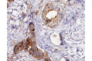 ABIN6266873 at 1/100 staining human Prostate cancer tissue sections by IHC-P. (STEAP4 antibody  (C-Term))