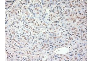 Immunohistochemical staining of paraffin-embedded Adenocarcinoma of ovary tissue using anti-SOX17 mouse monoclonal antibody.