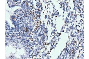 Immunohistochemical staining of paraffin-embedded Adenocarcinoma of Human endometrium tissue using anti-ARHGAP25 mouse monoclonal antibody.