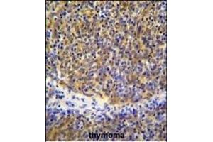 PSMB11 Antibody (C-term) (ABIN655286 and ABIN2844876) immunohistochemistry analysis in formalin fixed and paraffin embedded human thymoma followed by peroxidase conjugation of the secondary antibody and DAB staining. (PSMB11 antibody  (C-Term))