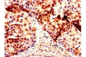 Immunohistochemistry of paraffin-embedded human breast cancer using ABIN7150637 at dilution of 1:100 (DMRT1 antibody  (AA 195-363))