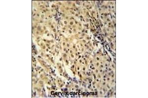 FOXC2 Antibody (Center ) (ABIN651936 and ABIN2840463) immunohistochemistry analysis in formalin fixed and paraffin embedded human cervix carcinoma followed by peroxidase conjugation of the secondary antibody and DAB staining. (FOXC2 antibody  (AA 159-186))