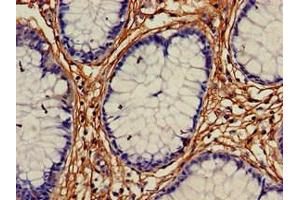 Immunohistochemistry of paraffin-embedded human colon cancer using ABIN7167768 at dilution of 1:100 (ALDH1A2 antibody  (AA 1-518))