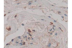 DAB staining on IHC-P; Samples: Human Breast cancer Tissue (Cathepsin D antibody  (AA 169-408))