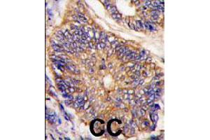 Formalin-fixed and paraffin-embedded human colon carcinoma tissue reacted with LDLRAP1 polyclonal antibody  , which was peroxidase-conjugated to the secondary antibody, followed by DAB staining. (LDLRAP1 antibody  (N-Term))