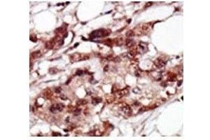 IHC analysis of FFPE human breast carcinoma tissue stained with the BRD4 antibody (BRD4 antibody  (AA 1313-1342))