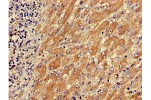 Immunohistochemistry of paraffin-embedded human liver cancer using ABIN7173558 at dilution of 1:100 (TPM3 antibody  (AA 18-224))