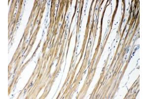 IHC testing of FFPE human intestinal cancer tissue with GJC1 antibody at 1ug/ml. (GJC1 antibody  (AA 91-131))