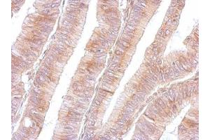 IHC-P Image B3GNT3 antibody detects B3GNT3 protein at cytosol on human colon by immunohistochemical analysis. (B3GNT3 antibody)
