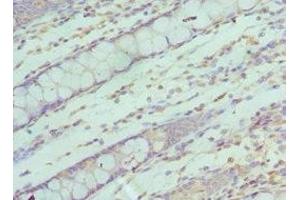 Immunohistochemistry of paraffin-embedded human colon cancer using ABIN7170622 at dilution of 1:100 (SF3B2 antibody  (AA 616-895))