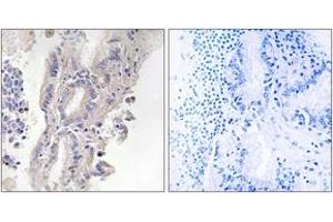 Immunohistochemistry analysis of paraffin-embedded human lung carcinoma, using PLCXD1 Antibody. (PLCXD1 antibody  (AA 187-236))