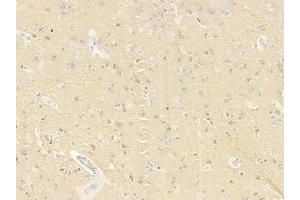 ABIN6259890 and ABIN6279111 at 1/100 staining human glioblastoma by IHC-P. (ALMS1 antibody  (C-Term))