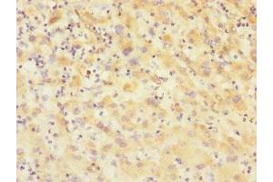Immunohistochemistry of paraffin-embedded human lung cancer using ABIN7175348 at dilution of 1:100 (VARS antibody  (AA 1-280))