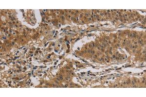 Immunohistochemistry of paraffin-embedded Human gastic cancer using CASP3 Polyclonal Antibody at dilution of 1:30 (Caspase 3 antibody)