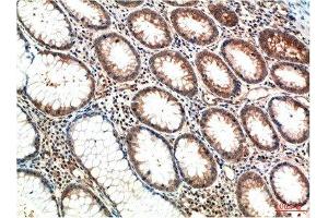Immunohistochemical analysis of paraffin-embedded Human Colon Carcinoma Tissue using ATM Mouse mAb diluted at 1:200. (ATM antibody)
