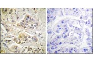 Immunohistochemistry analysis of paraffin-embedded human breast carcinoma tissue, using AhR (Ab-36) Antibody.