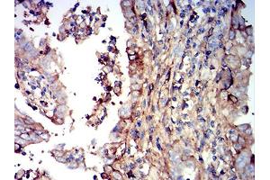 Immunohistochemical analysis of paraffin-embedded endometrial cancer tissues using IGHM mouse mAb with DAB staining. (IGHM antibody  (AA 310-452))